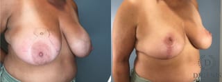 Before and after Breast Lift with or without Implants case 43076 - Angle 4