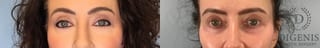 Before and after Laser Skin Resurfacing case 43078 - Angle 1