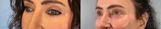 Before and after Laser Skin Resurfacing case 43078 - Angle 2
