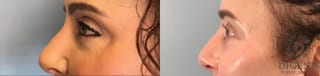 Before and after Laser Skin Resurfacing case 43078 - Angle 3