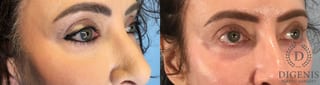 Before and after Laser Skin Resurfacing case 43078 - Angle 4