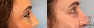 Before and after Laser Skin Resurfacing case 43078 - Angle 5