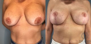 Before and after Breast Lift with or without Implants case 43079 - Angle 1