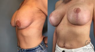 Before and after Breast Lift with or without Implants case 43079 - Angle 2