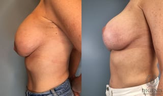Before and after Breast Lift with or without Implants case 43079 - Angle 3