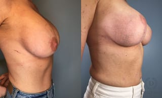 Before and after Breast Lift with or without Implants case 43079 - Angle 4