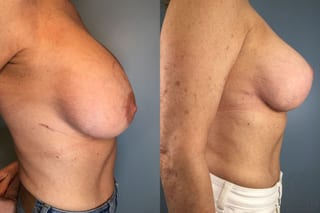 Before and after Breast Lift with or without Implants case 43079 - Angle 5