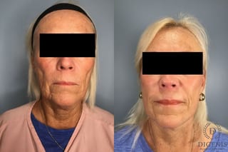 Before and after Laser Skin Resurfacing case 43228 - Angle 1