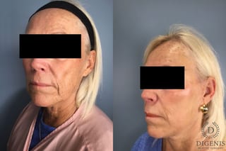 Before and after Laser Skin Resurfacing case 43228 - Angle 2