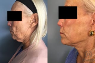 Before and after Laser Skin Resurfacing case 43228 - Angle 3