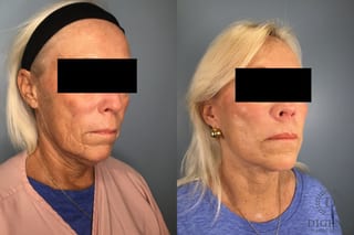 Before and after Laser Skin Resurfacing case 43228 - Angle 4
