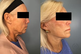 Before and after Laser Skin Resurfacing case 43228 - Angle 5