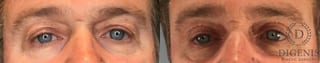 Before and after Eye Lid Surgery case 43247 - Angle 1