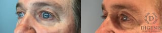 Before and after Eye Lid Surgery case 43247 - Angle 2