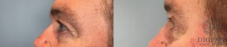 Before and after Eye Lid Surgery case 43247 - Angle 3