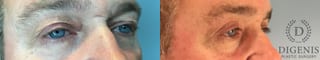 Before and after Eye Lid Surgery case 43247 - Angle 4