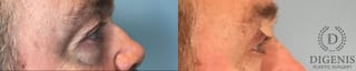 Before and after Eye Lid Surgery case 43247 - Angle 5