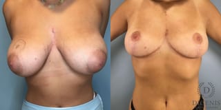 Before and after Breast Reduction case 43251 - Angle 1