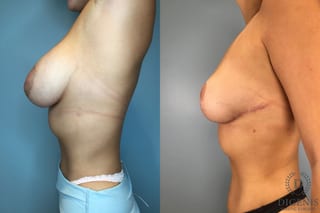 Before and after Breast Reduction case 43251 - Angle 3