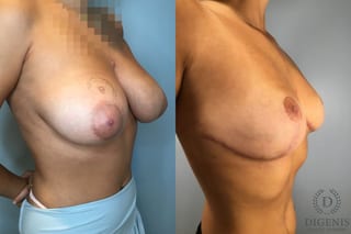 Before and after Breast Reduction case 43251 - Angle 4