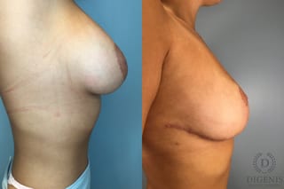 Before and after Breast Reduction case 43251 - Angle 5