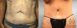 Before and after Tummy Tuck case 43252 - Angle 1