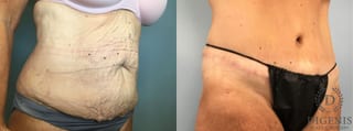 Before and after Tummy Tuck case 43252 - Angle 2