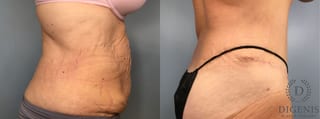 Before and after Tummy Tuck case 43252 - Angle 3