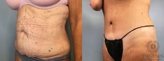 Before and after Tummy Tuck case 43252 - Angle 4