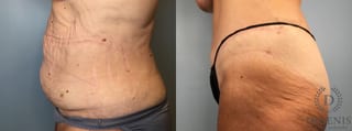 Before and after Tummy Tuck case 43252 - Angle 5