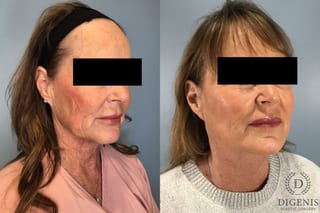 Before and after Face Lift/Neck Lift case 43259 - Angle 1