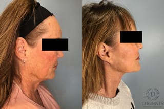 Before and after Face Lift/Neck Lift case 43259 - Angle 2