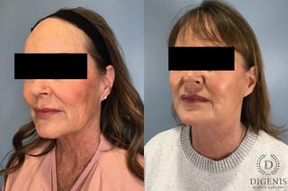 Before and after Face Lift/Neck Lift case 43259 - Angle 3