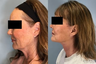 Before and after Face Lift/Neck Lift case 43259 - Angle 4
