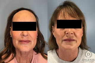 Before and after Face Lift/Neck Lift case 43259 - Angle 5