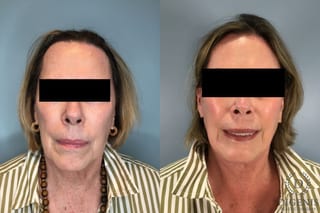 Before and after Face Lift/Neck Lift case 43260 - Angle 1
