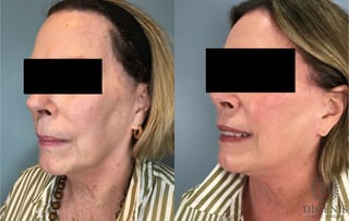 Before and after Face Lift/Neck Lift case 43260 - Angle 2