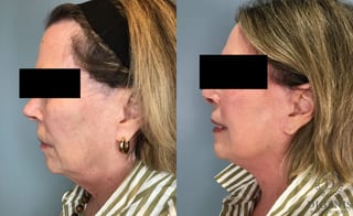 Before and after Face Lift/Neck Lift case 43260 - Angle 3