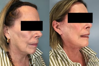 Before and after Face Lift/Neck Lift case 43260 - Angle 4