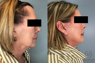Before and after Face Lift/Neck Lift case 43260 - Angle 5