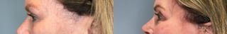 Before and after Eye Lid Surgery case 43261 - Angle 2