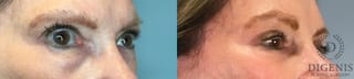 Before and after Eye Lid Surgery case 43261 - Angle 3