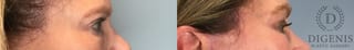 Before and after Eye Lid Surgery case 43261 - Angle 4