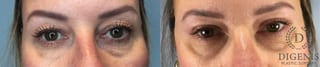 Before and after Eye Lid Surgery case 43329 - Angle 1
