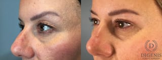 Before and after Eye Lid Surgery case 43329 - Angle 2