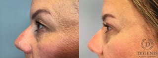 Before and after Eye Lid Surgery case 43329 - Angle 3