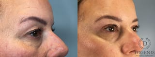 Before and after Eye Lid Surgery case 43329 - Angle 4
