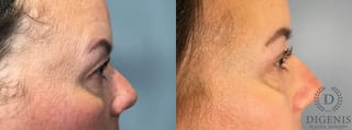 Before and after Eye Lid Surgery case 43329 - Angle 5