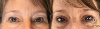 Before and after Eye Lid Surgery case 43348 - Angle 1