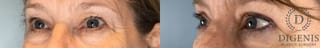 Before and after Eye Lid Surgery case 43348 - Angle 2